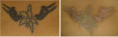 After 3 Laser Removal Treatment